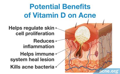 This is a natural way to cure your pimples. Does Vitamin D Help Treat Acne? - Acne.org