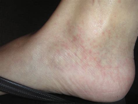 Red Spots On Ankles Pictures Photos