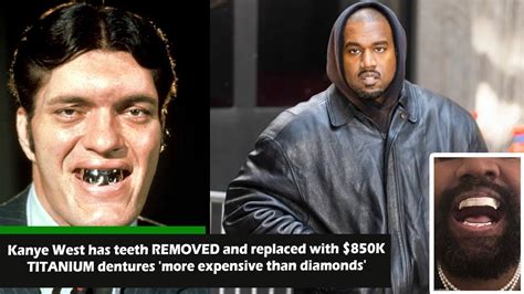 Kanye West Has Teeth Removed And Replaced With 850k Titanium Dentures