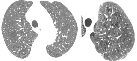 Axial Ct Scans With Lung Window Settings Revealing Centrilobular