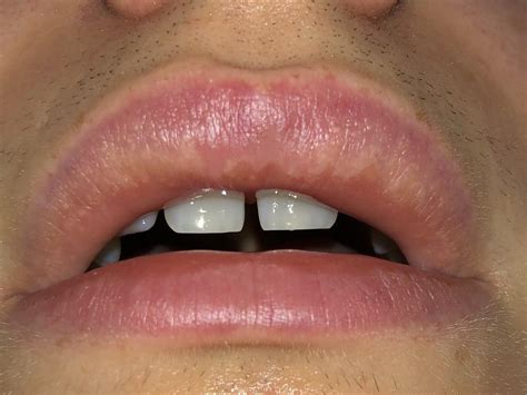 White Spots On Lips From Filler
