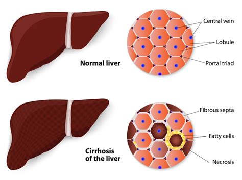 Cirrhosis Of The Liver Causes Symptoms And Treatments Medical News