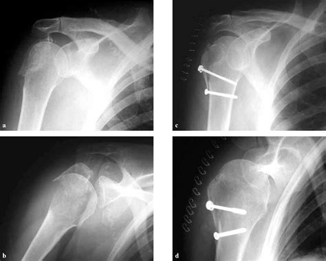 Figure 5 From Internal Fixation Of Proximal Humeral Fractures