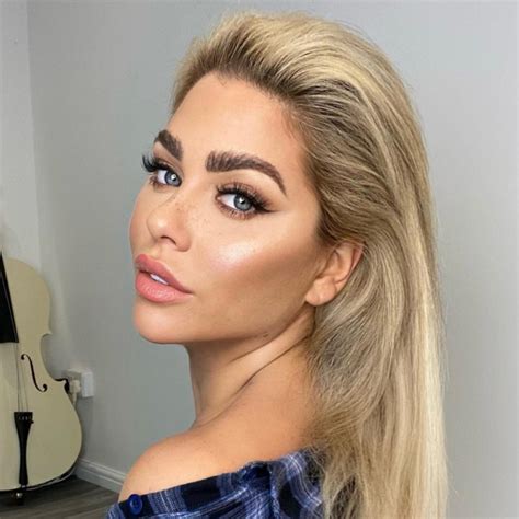 Bianca Gascoigne Hair Transplant At Ksl Clinic See The Results Here