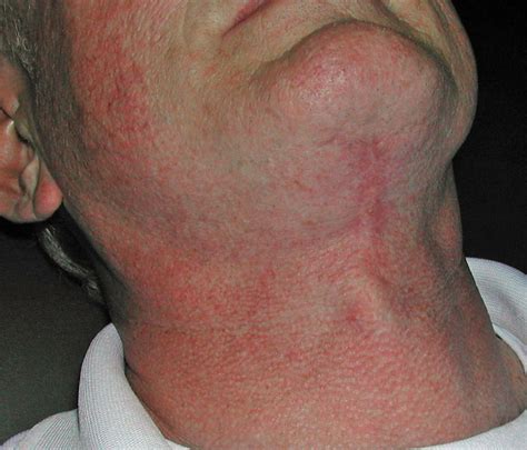 The Direct Neck Lift Scar What Does It Look Like Explore Plastic