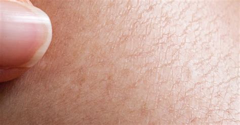 Natural Remedies For Extremely Dry Skin Livestrongcom