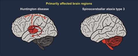 Brain Regions Primarily Affected In Huntington Disease And