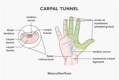Carpal Tunnel Syndrome Causes Symptoms And Treatment 2023