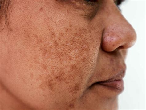 Manchas en la piel Cómo eliminarlas y cuándo acudir al dermatólogo FarmaLink