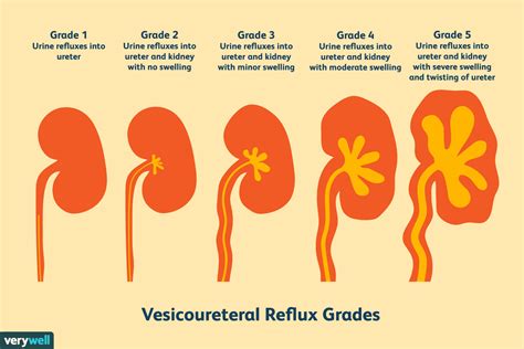 vesicoureteral reflux symptoms causes and treatment