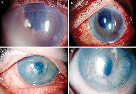 Pseudophakic Bullous Keratopathy With Anterior Chamber Lens B
