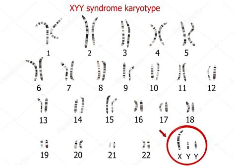 Xyy Syndrome Supermale Karyotype — Stock Vector