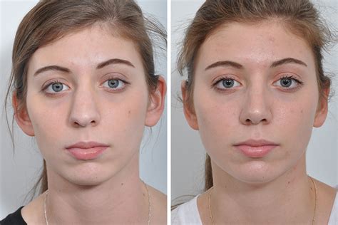 Is Rhinoplasty Nose Surgery Effective For A Crooked Nose