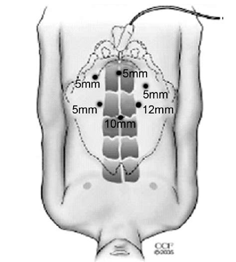 Port Placement During Laparoscopic Radical Prostatectomy Download Scientific Diagram