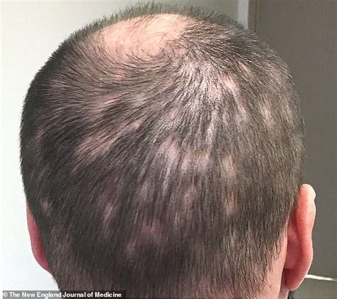 Man Starts To Go Bald After Developing Alopecia From His Syphilis