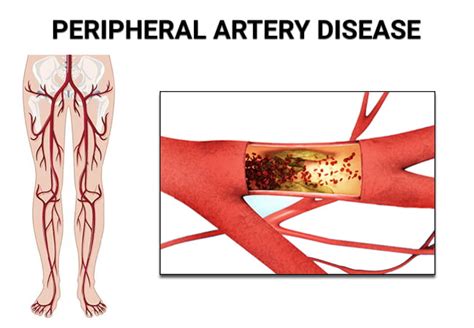 Peripheral Artery Disease Treatment Vein And Endovascular Medical Care