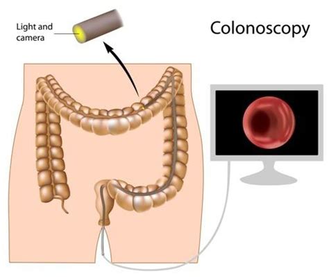 Colonsocopy Procedure Louisville KY Colon Test Colorectal Screening