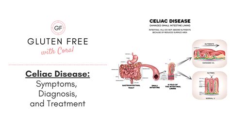 Celiac Disease Symptoms Diagnosis And Treatment Gluten Free With Coral