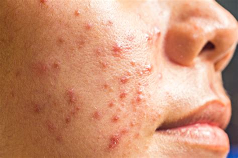 How Do You Get Rid Of Cystic Acne