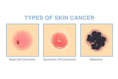 Skin Cancer Early Detection: Signs to Watch For | Dermatology Associates
