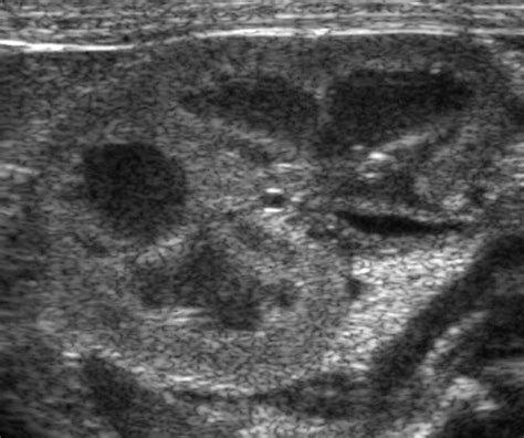 Renal Pyramids Focused Sonography Of Normal And Pathologic Processes