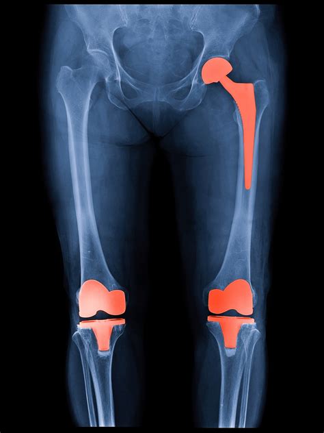 How Long Will My Hip Or Knee Replacement Last Harvard Health