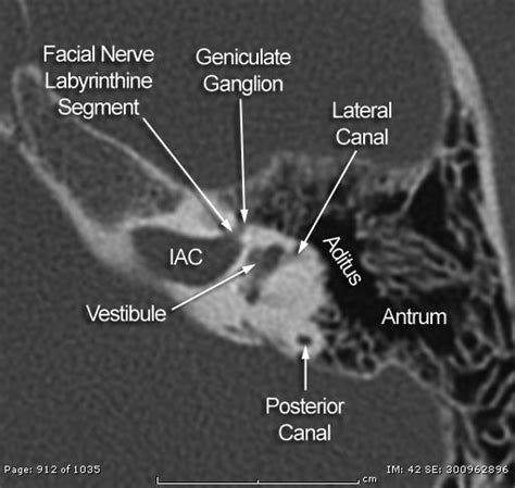 Ct Scan Tips And Protocols Ct Temporal Bone Anatomy Diagnostic Imaging