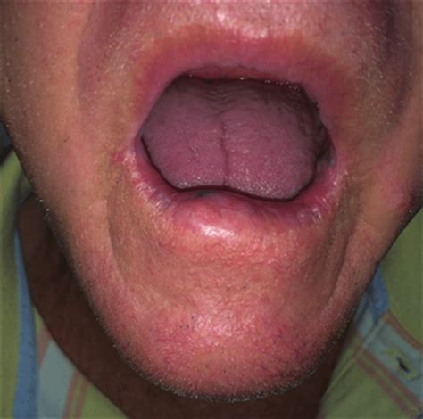 Presence Of Lump In The Midline Region Of The Lower Lip Download