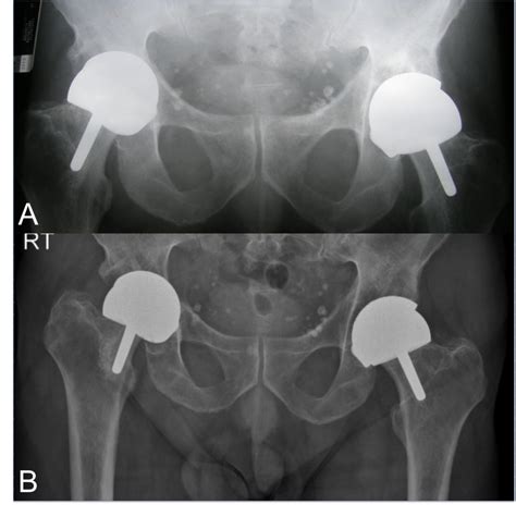 METAL DEBRIS DISEASE CASE TWO: Osteolysis Secondary to Metalosis — Complex Hip Surgery