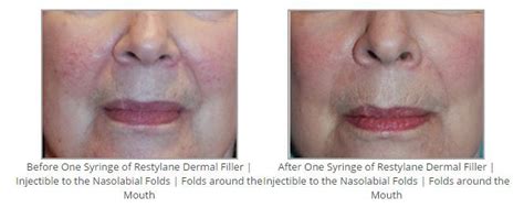 Before And After One Syringe Of Restylane Dermal Filler Injectible To