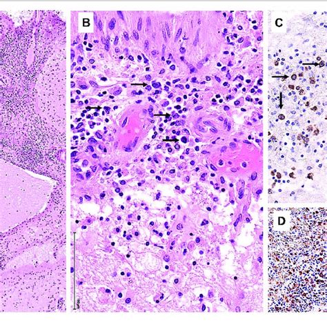 Brain Biopsy A E And Csf F A Low Power View Of The Brain