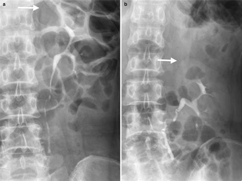 Normal Variant And Congenital Anomalies Radiology Key