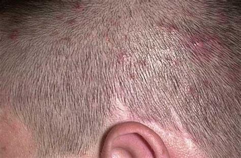 Folliculitis Hot Tub Rash And Inflammation Herbal Care Products Blog