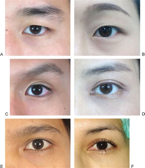 Asian Eyelid Morphologies Are Categorized Into Six Types A Single