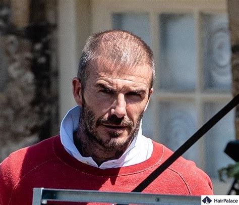 David Beckham Hair Transplant Story The Shocking Truth