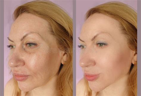 Woman Face Wrinkles Before Result Tension Procedure After Removal