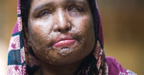 Acid Attack Victims Need Equality To Help Stop Violence Says