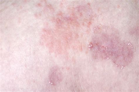 Dermatitis Herpetiformis Duhring Dermanostic