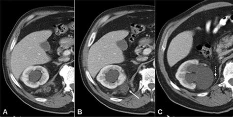 Bochdalek Hernia With Obstructive Uropathy Urology