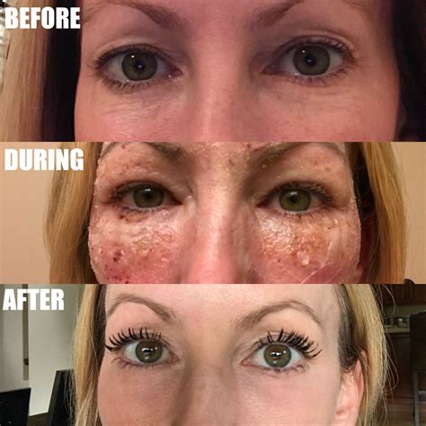 The Stylish Housewife Co2 Laser Before And After Archives The Stylish