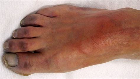 What You Need To Know About Peripheral Cyanosis Blue Hands And Feet