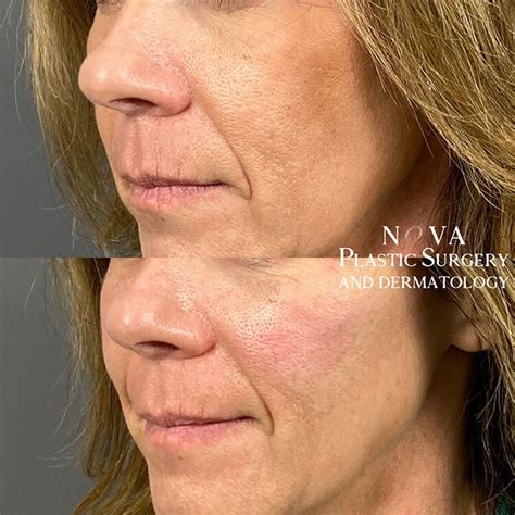 Cosmetic Dermal Fillers Injections Treatments In Northern VA