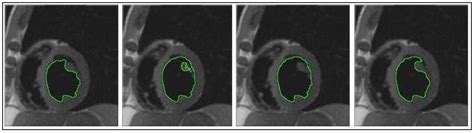 Images 1 2 And 3 Chan And Vese Model 4 With Shape Prior Iter 30