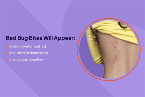 What Are Bed Bugs Bites Dangerous For Treatment And P Vrogue Co