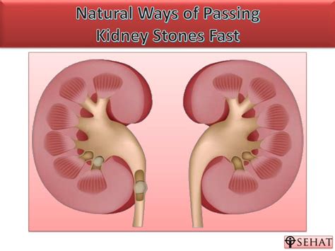 Ppt Natural Ways Of Passing Kidney Stones Powerpoint