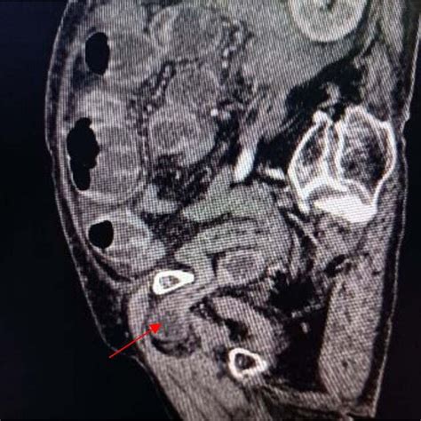 Sagittal View Shows A Right Obturator Hernia Indicated By Red Arrow