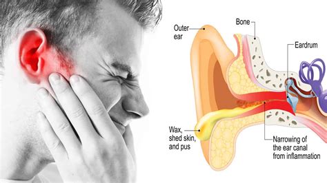 Doctors Reveal 6 Natural Remedies for Swimmers Ear | 5 Minute Read