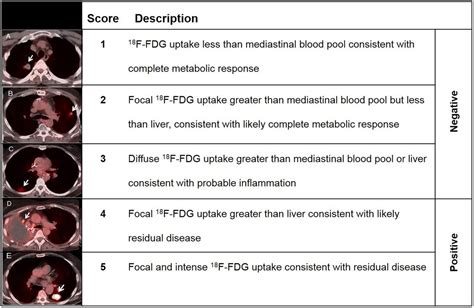 18f Fdg Petct Therapy Response Assessment Interpretation Hopkins