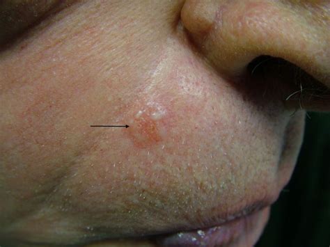 Morphoeic Basal Cell Carcinoma