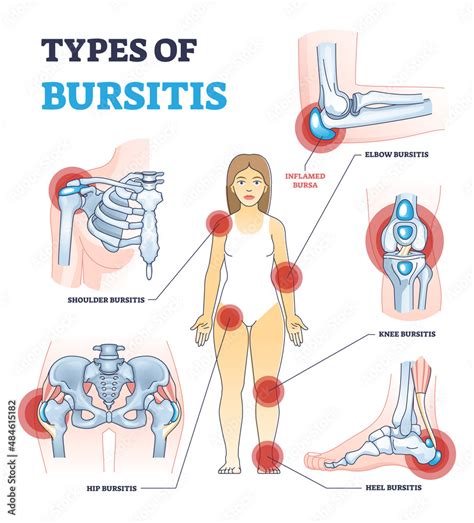 Stockvector Types Of Bursitis As Medical Body Joints Inflammation List